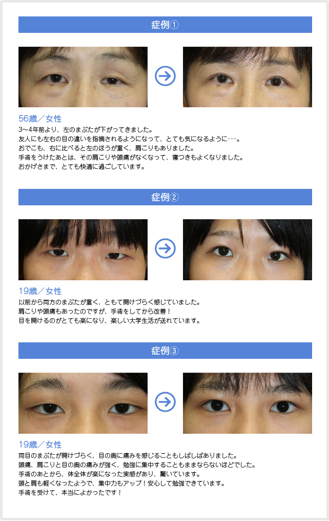 眼瞼下垂症状