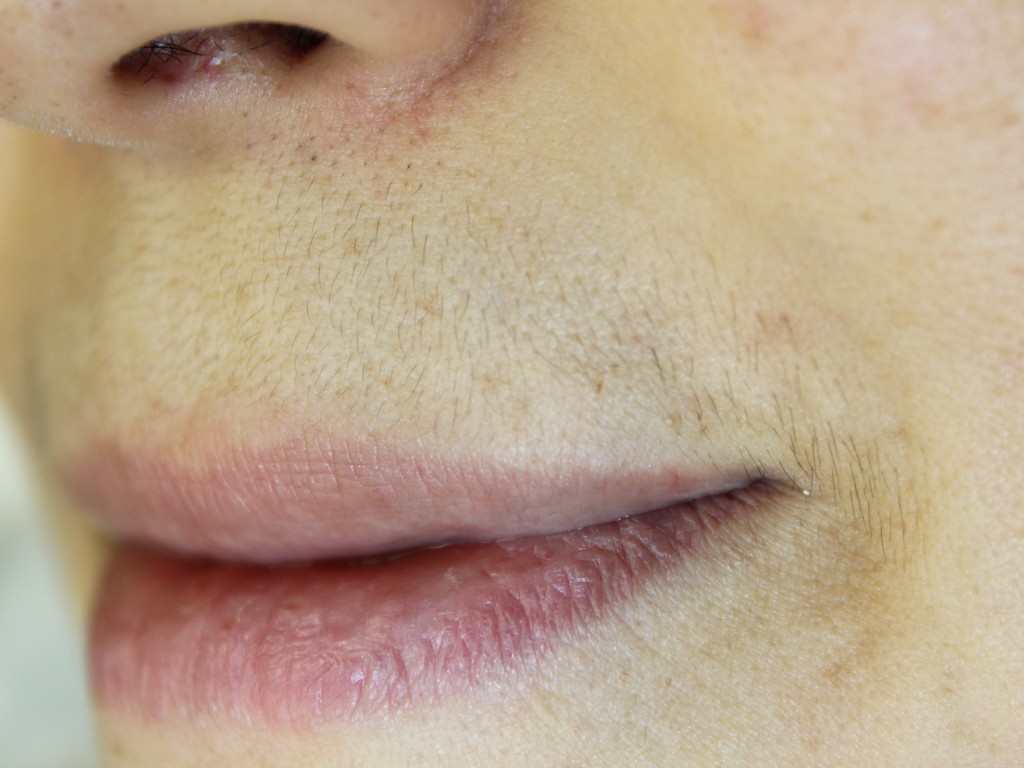 レーザー脱毛 －口周りのうぶ毛治療－ SSクリニック 皮膚科・美容外科 名古屋市中区