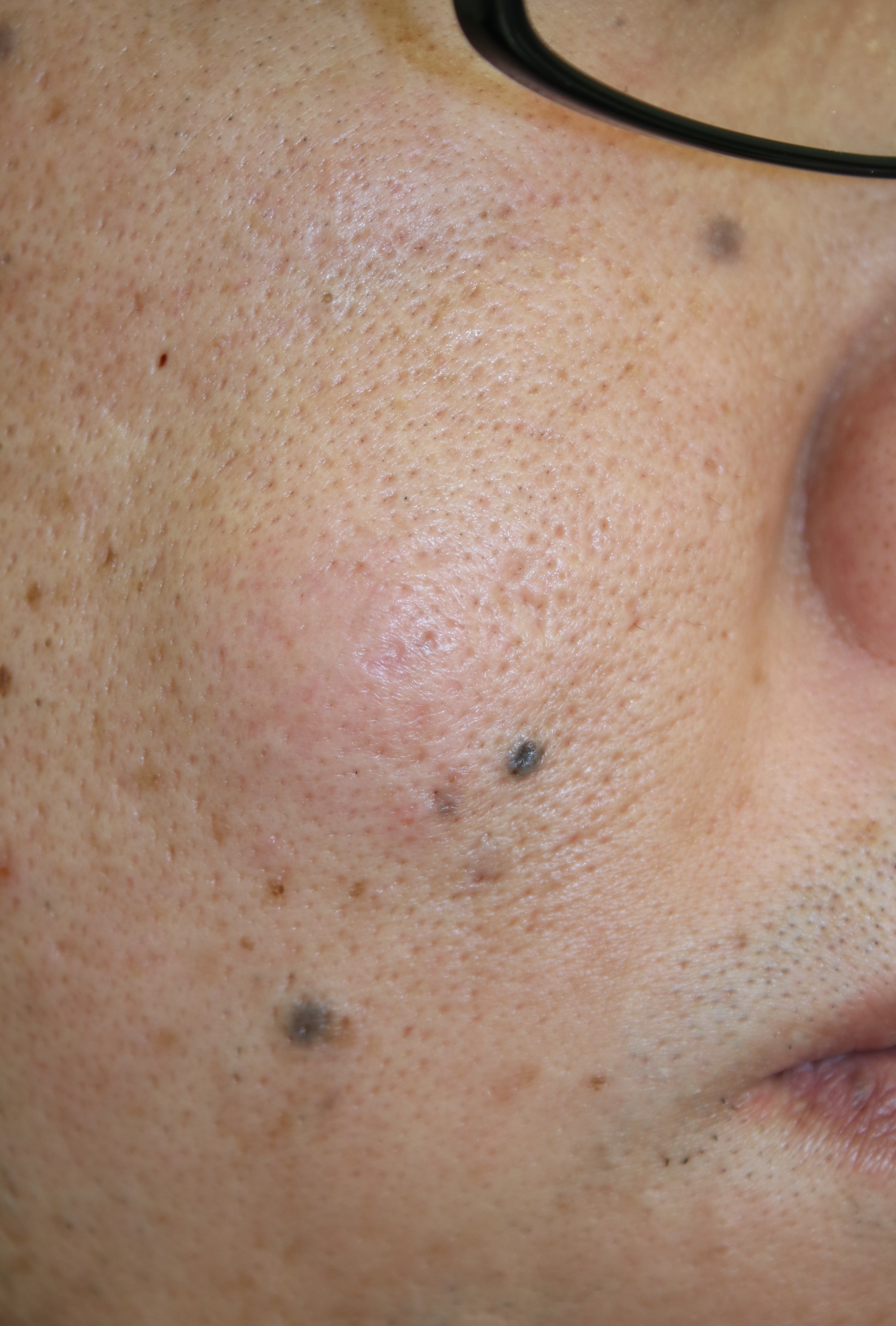 疥瘡堪稱「最癢皮膚病」傳染力強 5招預防 | 症狀 | 藥物 | 疥蟲 | 大紀元
