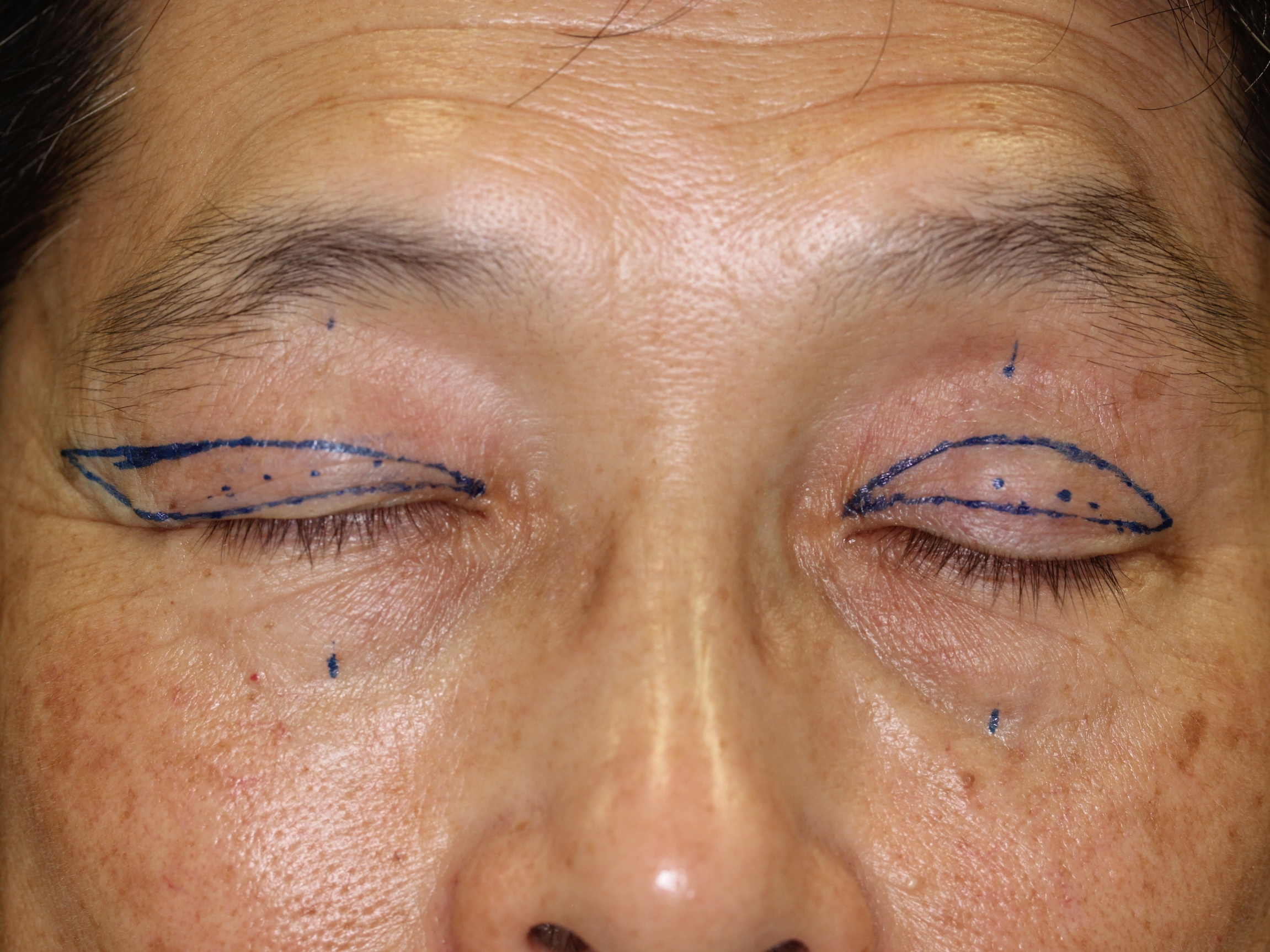 眼瞼下垂 Ssクリニック 皮膚科 美容外科 名古屋市中区