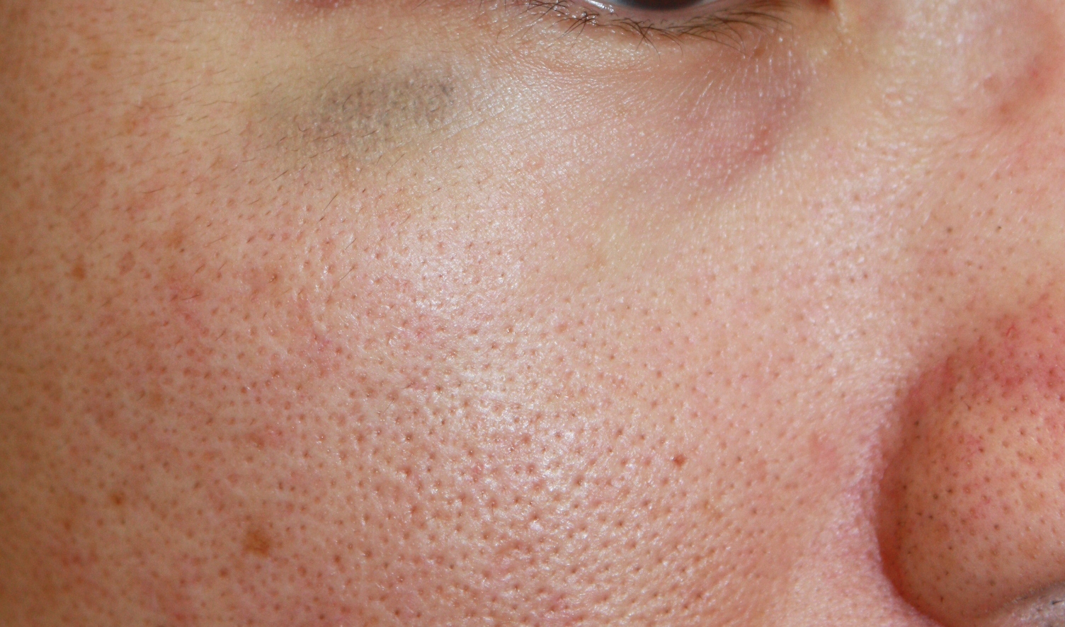 外傷性異物沈着症のレーザー治療 Ssクリニック 皮膚科 美容外科 名古屋市中区