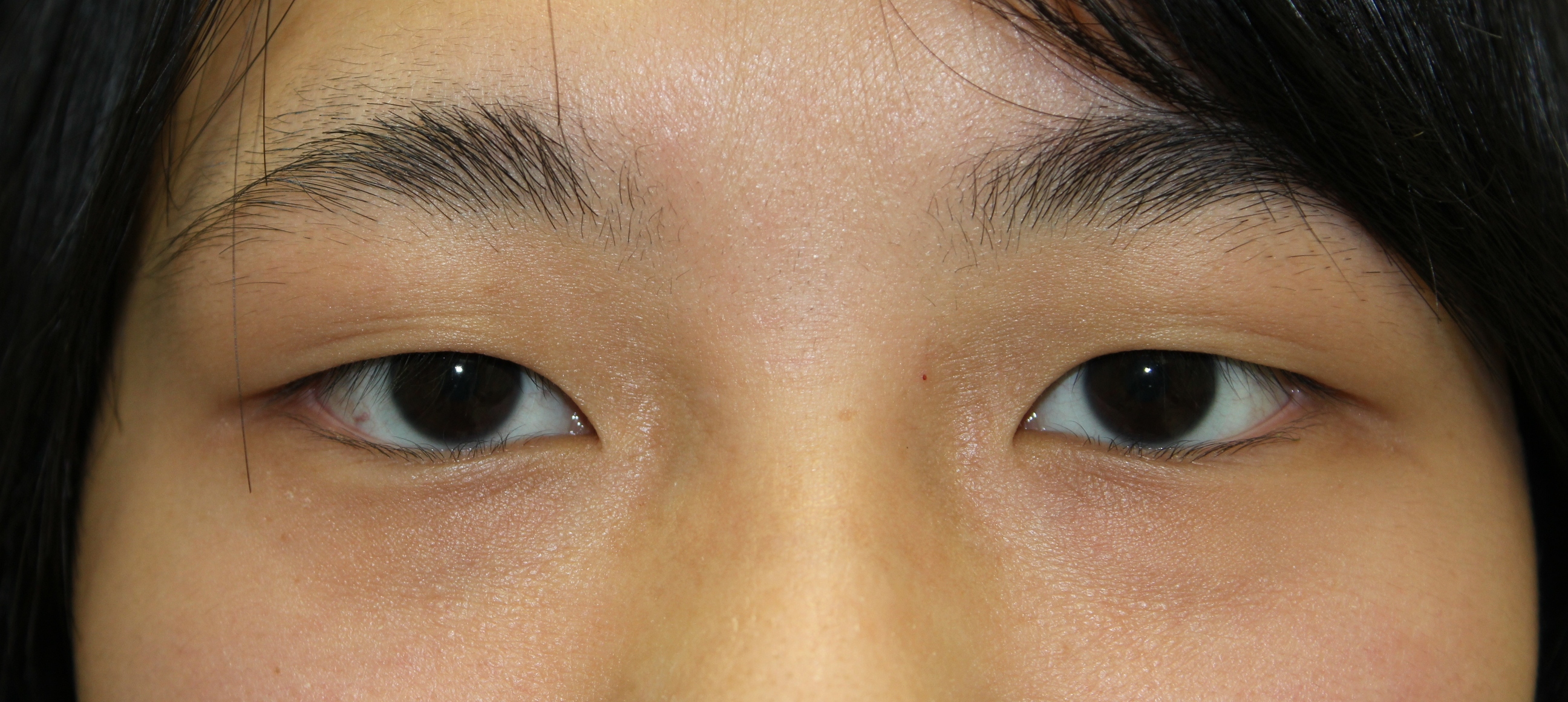 下垂 トレーニング 眼瞼 目瞼下垂をセルフチェック！自力で改善する４つの方法