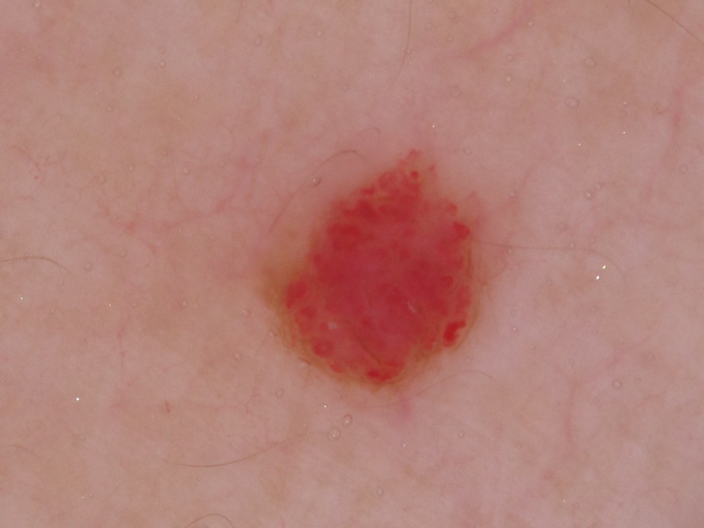 老人性血管腫 -胸元をすっきりと- SSクリニック 皮膚科・美容外科 名古屋市中区 老人性血管腫 -胸元をすっきりと- SSクリニック 皮膚科・美容外科 名古屋市中区