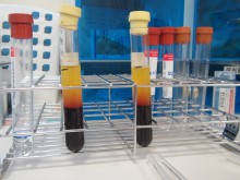 多血小板血漿療法　－PRPアドバンス－