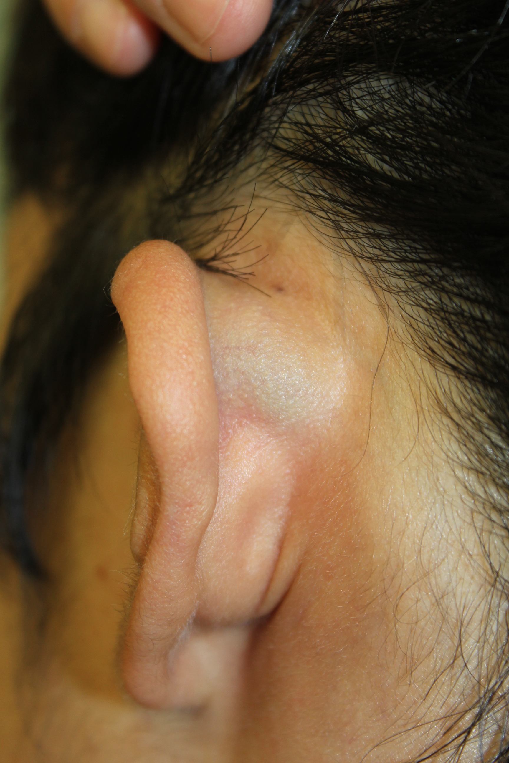耳朵软骨炎的症状图,耳廓红肿 - 伤感说说吧