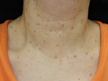 頚部のぶつぶつ
