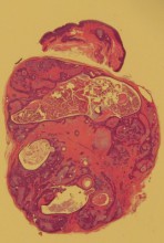 それは粉瘤ではない！ －皮膚混合腫瘍－