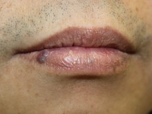 口唇の血管腫　－静脈湖－