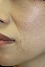 多血小板血漿療法（PRP） －頬の小じわ－