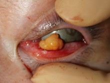 目の下のクマ　－経結膜除脂術－