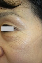 PRPアドバンス　－目の周りの小じわ－