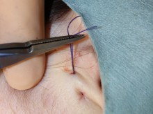 切らないフェイスリフト　－n-COGの効果－