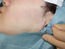 切らないフェイスリフト　－n-COG  進化する固定法－