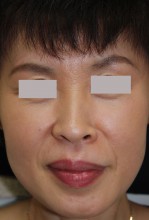 多血小板血漿療法 （PRP）　－効果の持続－