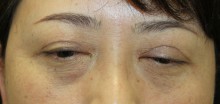 眼瞼下垂修正手術　　ごめんね？
