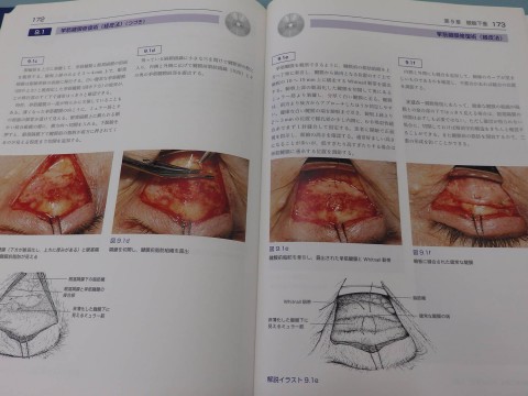 挙筋腱膜修復