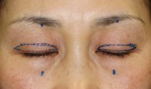 まぶたのくぼみを治す　－眼瞼下垂手術の応用－