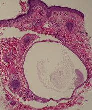 エクリン汗嚢腫　－ボトックスで治す－