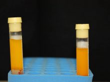 ほうれい線　シワの治療　－PRP治療の長期経過－