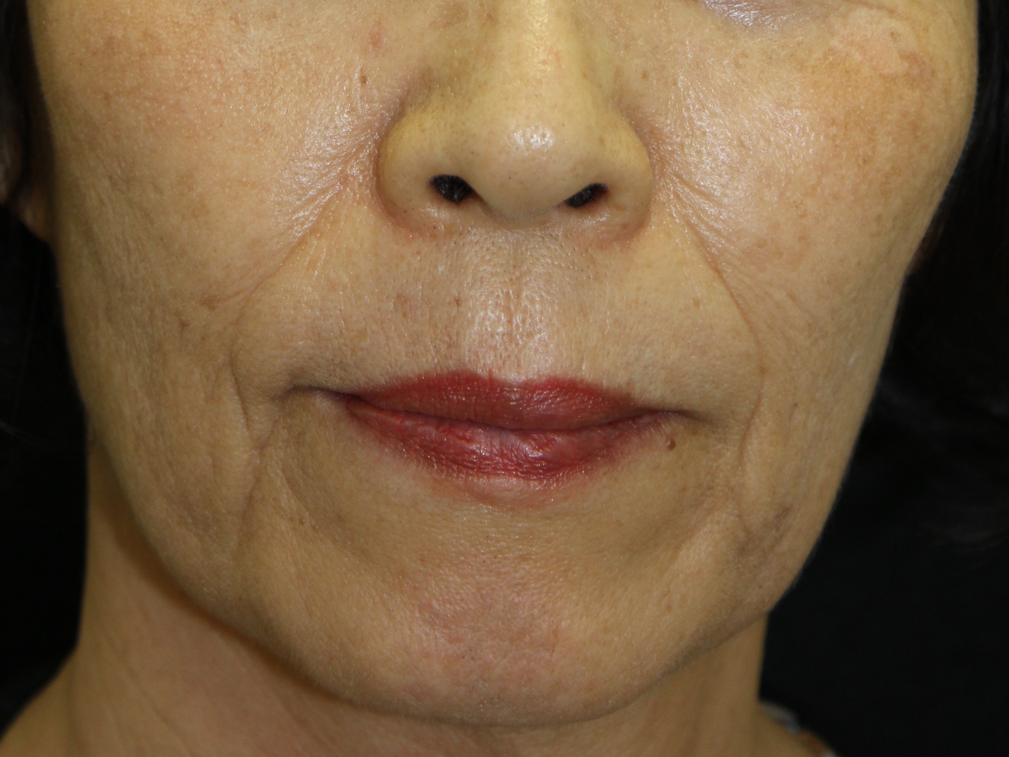 ほうれい線 シワの治療 Prp治療の長期経過 Ssクリニック 皮膚科 美容外科 名古屋市中区