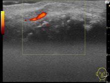 粉瘤以外の皮膚腫瘍１　-血管平滑筋腫-