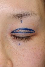 眼瞼下垂修正術　－5度目の正直－