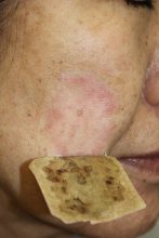 シミの他院修正