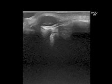 粉瘤以外の皮膚腫瘍２　ー神経鞘腫ー