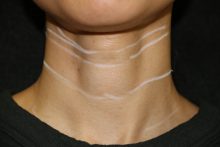再生医療による首のシワ治療　W-PRP