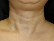 再生医療による首のシワ治療２　W-PRP