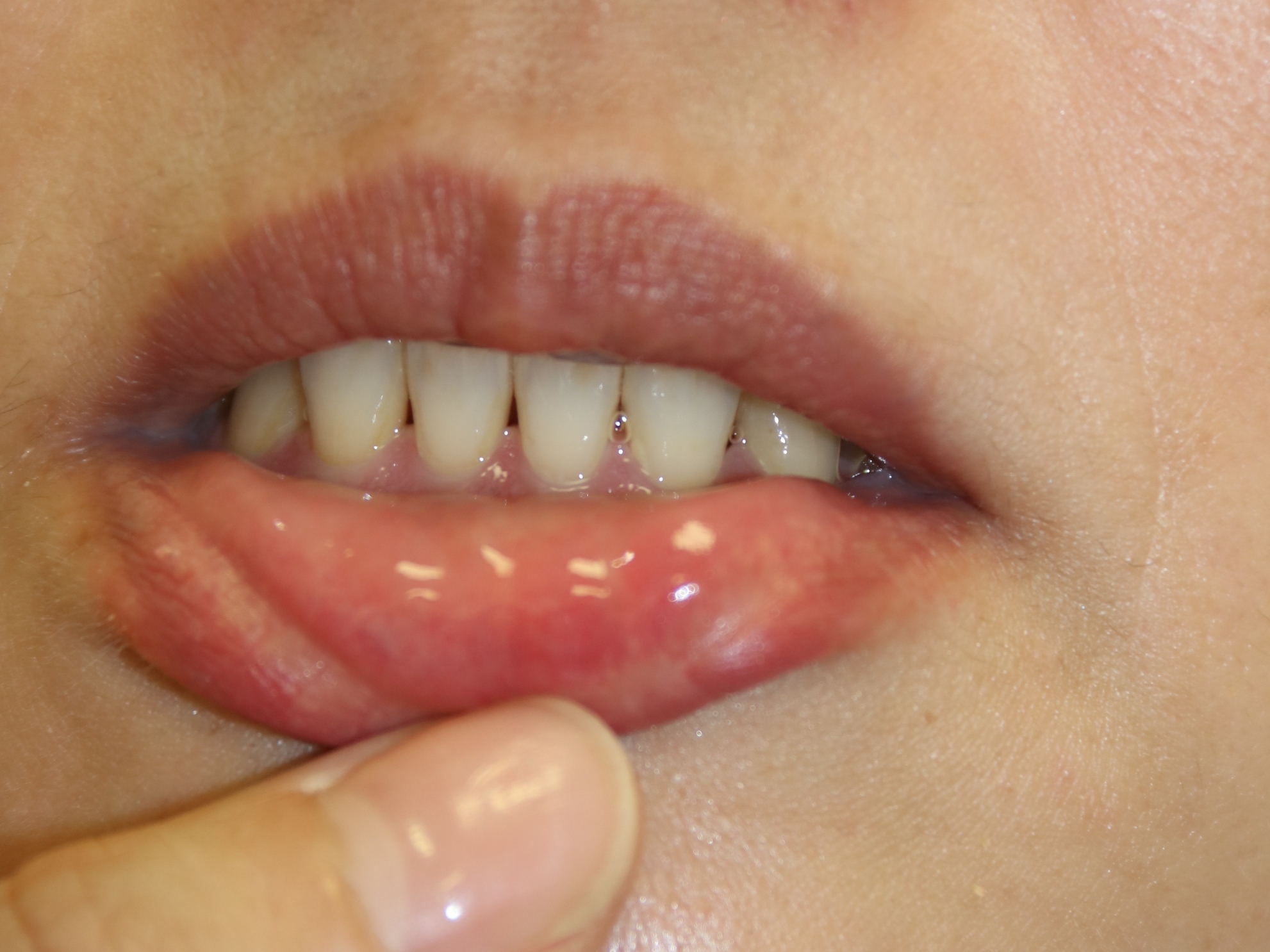腫れ 画像 唇 唇が腫れてたらこみたい！クインケ浮腫になる原因や即効性のある対処法