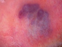 静脈湖（口唇の血管腫）　メスは嫌です！