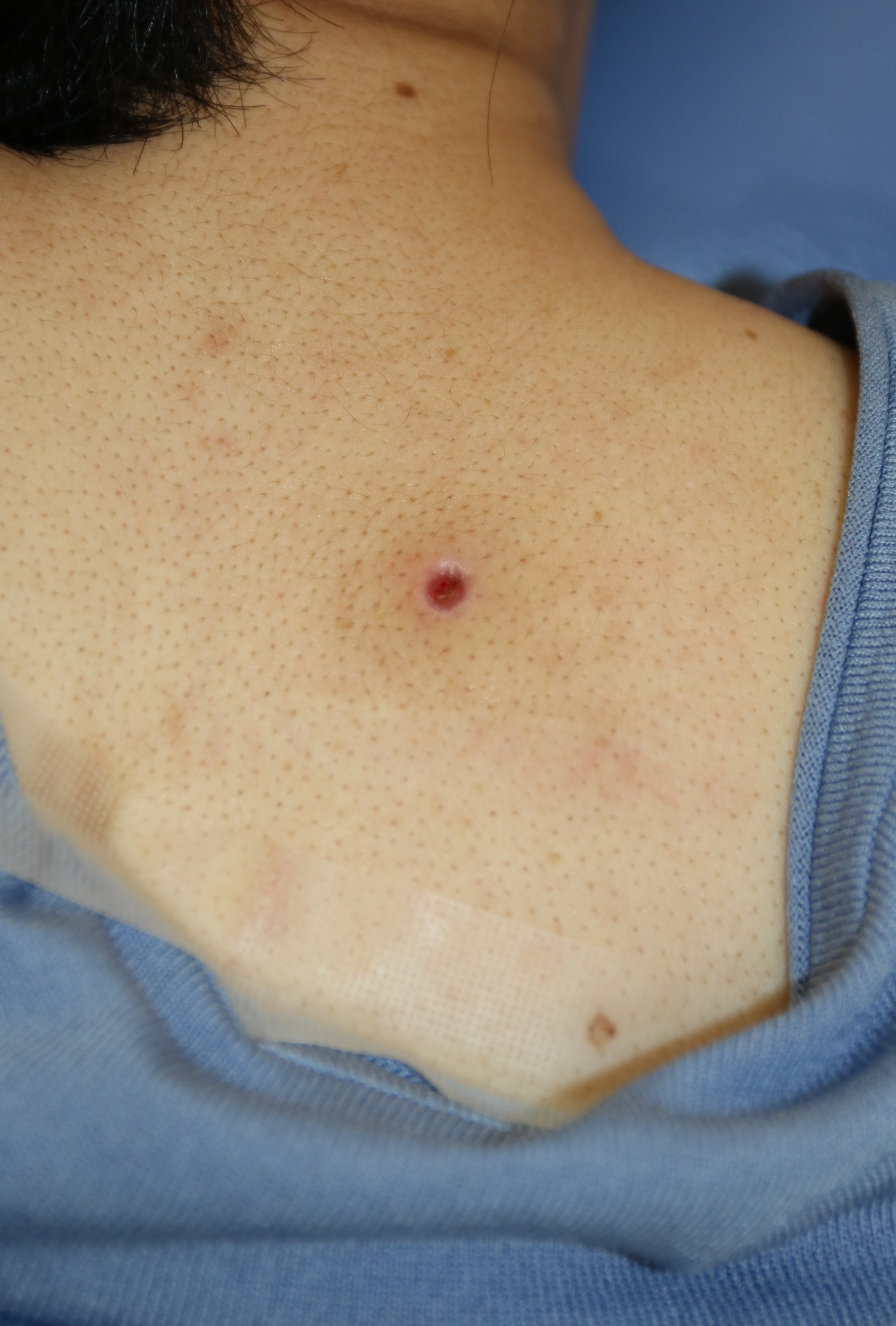 ふんりゅう だし 炎症性粉瘤 痛みのある化膿した赤い腫れがある場合 の治療