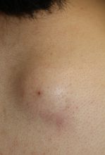 粉瘤くり抜き法　－どの大きさまでやれる？－　その１