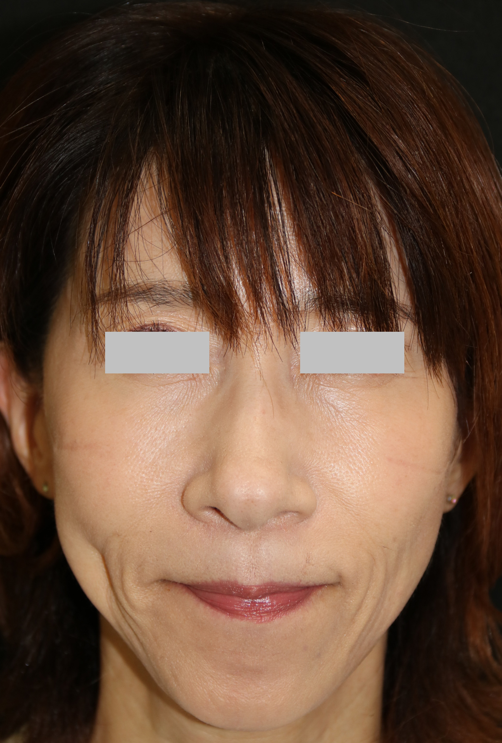 レディエッセとは ほうれい線治療 Ssクリニック 皮膚科 美容外科 名古屋市中区