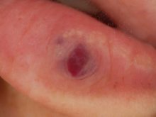 切らない血管腫治療　－静脈湖をきれいに治す－