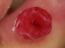 唇の血管拡張性肉芽腫　－よい治療とは－