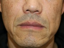 40歳代のほうれい線治療