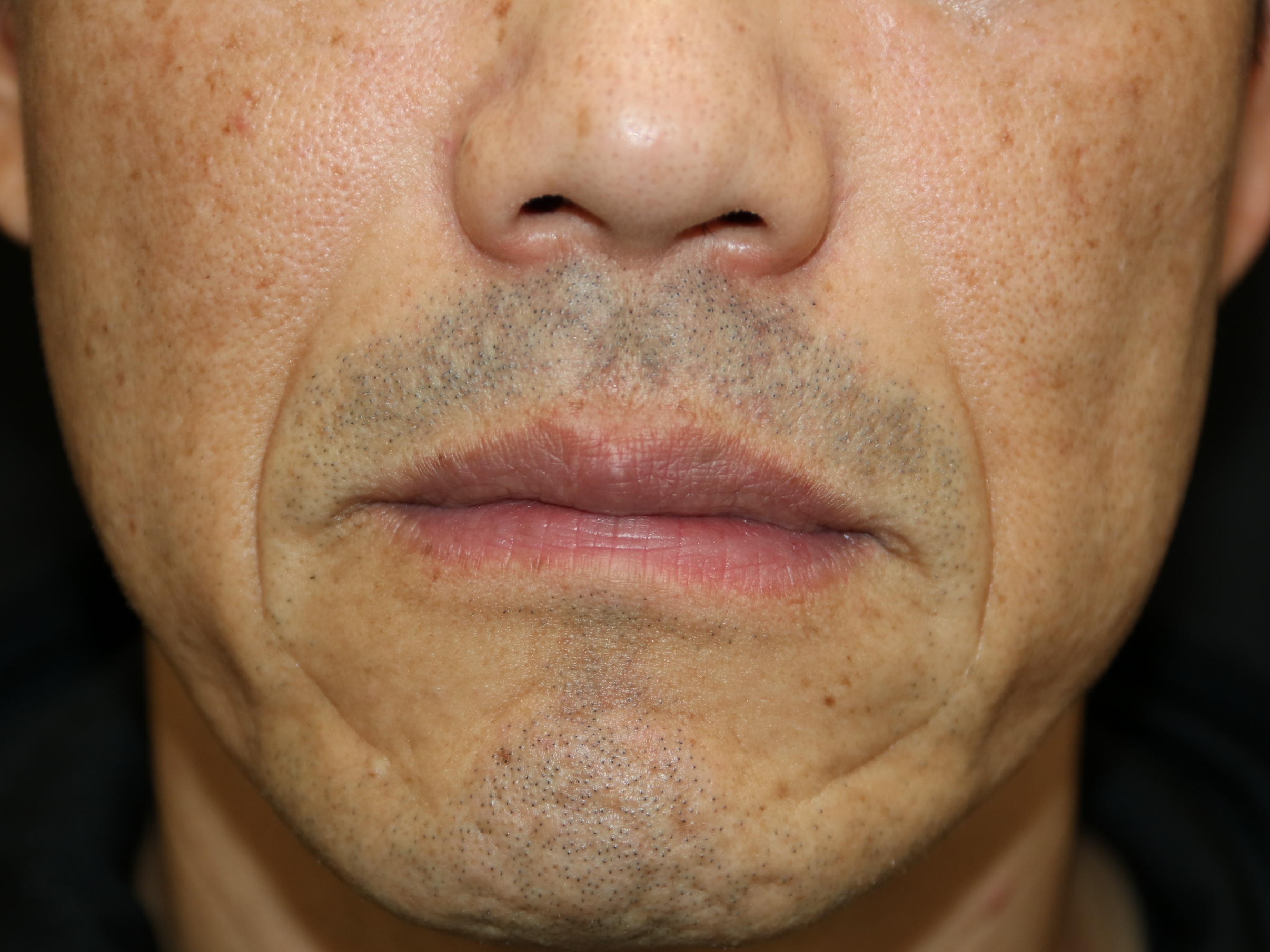 40歳代のほうれい線治療 Ssクリニック 皮膚科 美容外科 名古屋市中区