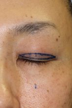 人生を変える眼瞼下垂手術　その２