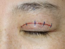 人生を取り戻す眼瞼下垂手術　ー修正術についてー