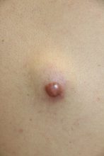 再発するくりぬき法　ダメだこりゃあ・・・