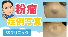 YouTube「粉瘤 症例写真」
