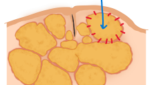 脂腺過形成（増殖症）　sebaceous hyperplasia