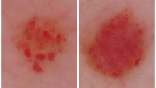 老人性血管腫を治す！