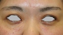 汗管腫 RFナイフ治療とは？