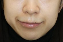 笑うと気になるお口元の  ーPRP治療その２ー