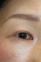 眼瞼下垂　ー他院修正術の経過 その2ー