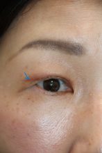 眼瞼下垂　ー他院修正術の経過 その1ー