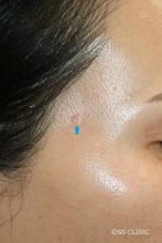 脂腺増殖症 ー凹ませない、再発させないー